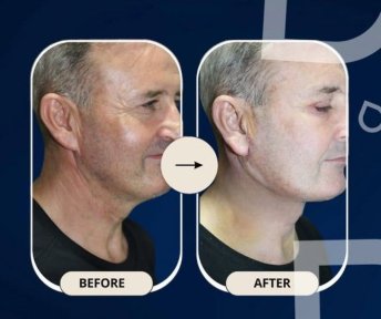 نتائج شد الرقبة قبل وبعد في عيادة TWT Health، تحسن واضح في شد الرقبة