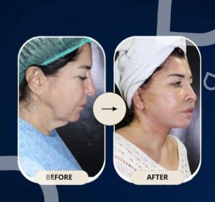 نتائج شد الرقبة قبل وبعد في عيادة TWT Health، شد واضح للفك والرقبة
