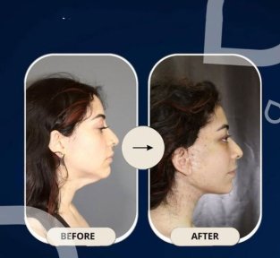 نتائج شد الرقبة قبل وبعد في TWT Health Clinic، تحسين تحديد الفك والرقبة