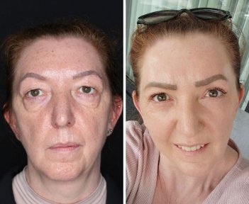 Facelift Vorher-Nachher-Ergebnisse bei Dr. Safa Manav Clinic – sichtbare Verjüngung
