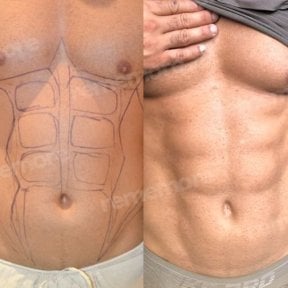 Before and after abdominal etching (six pack abs) results at Memorial Bahçelievler Hospital