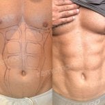 Before and after abdominal etching (six pack abs) results at Memorial Bahçelievler Hospital