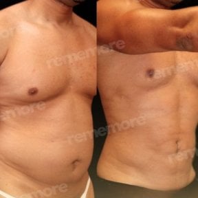 Before and after abdominal etching results at Memorial Bahçelievler Hospital, defined abs