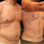 Before and after abdominal etching results at Memorial Bahçelievler Hospital, defined abs