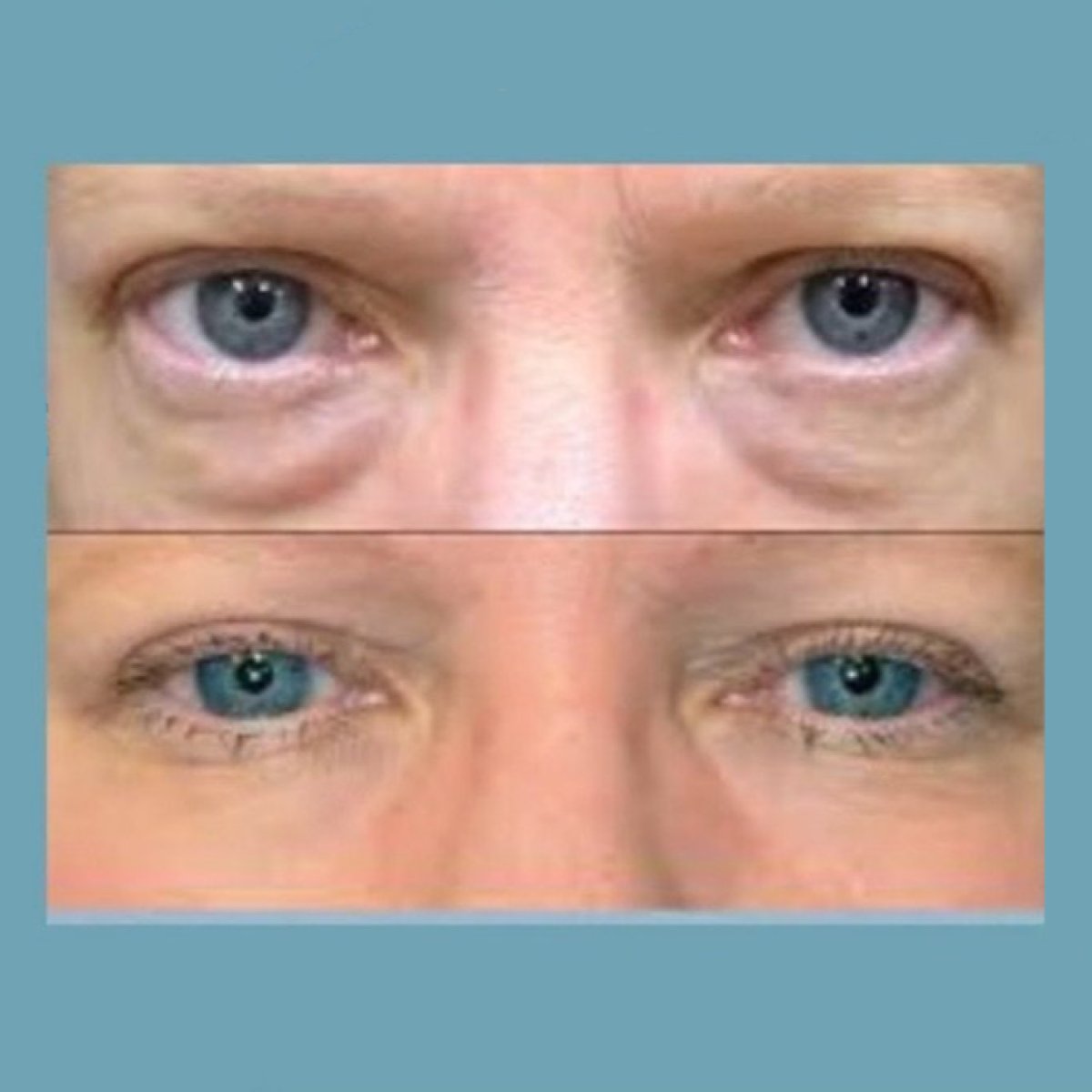Vorher-nachher-Ergebnis Unterlid-Blepharoplastik bei ID Clinic Bangkok, weniger Augenringe