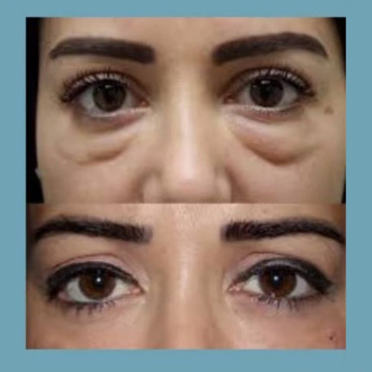 Vorher-nachher-Ergebnis Unterlid-Blepharoplastik bei ID Clinic Bangkok, weniger Augenringe
