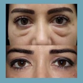 نتائج رأب الجفن السفلي قبل وبعد في ID Clinic Bangkok، تقليل الانتفاخات تحت العين