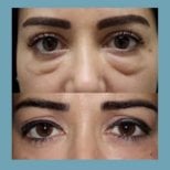 نتائج رأب الجفن السفلي قبل وبعد في ID Clinic Bangkok، تقليل الانتفاخات تحت العين