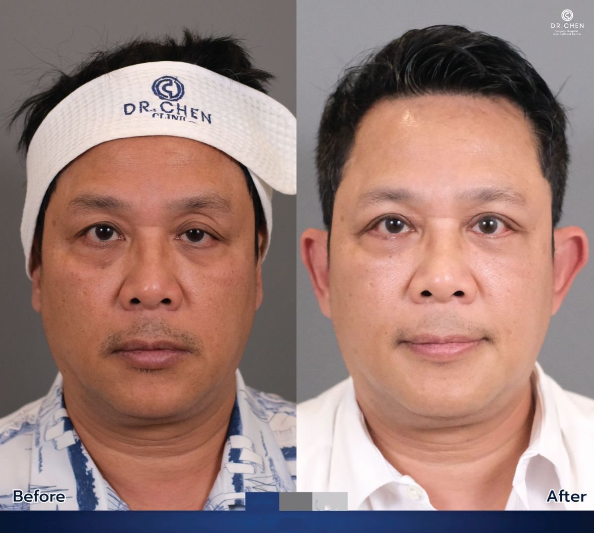 نتائج رأب الجفن قبل وبعد في Dr. Chen Surgery Hospital International Center