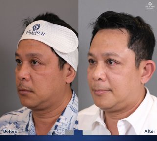 Before and after blepharoplasty results at Dr. Chen Surgery Hospital International Center