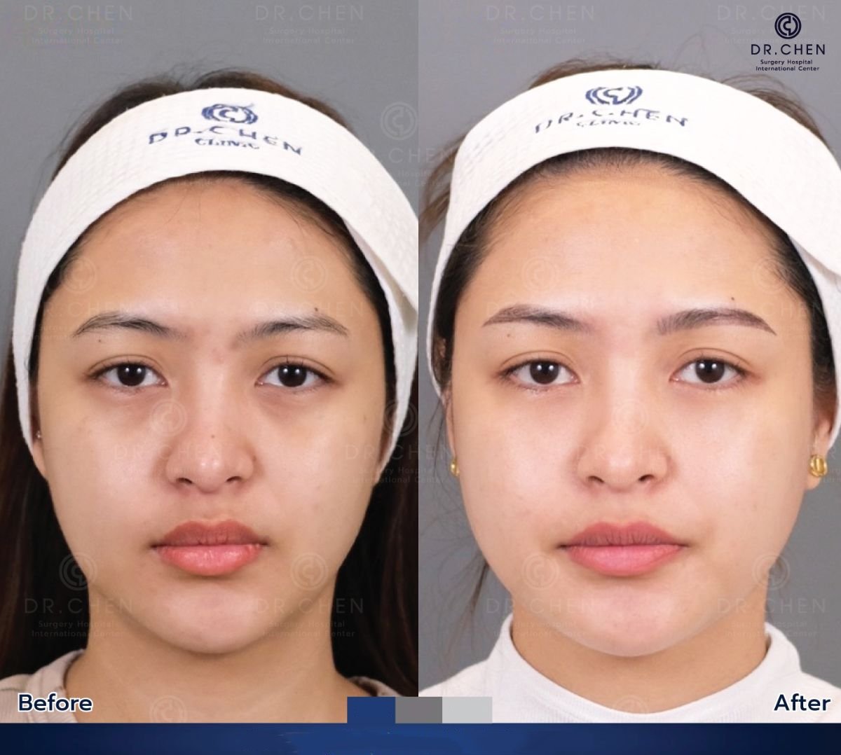 نتائج رأب الجفن قبل وبعد في Dr. Chen Surgery Hospital International Center
