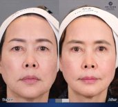 Before and after blepharoplasty results at Dr. Chen Surgery Hospital International Center