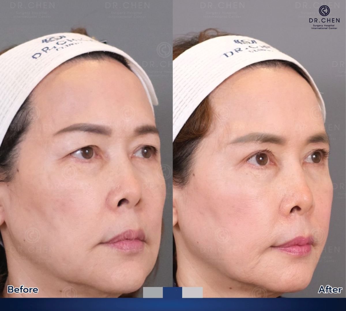 Resultados de blefaroplastia antes y después en Dr. Chen Surgery Hospital International Center