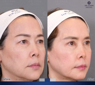 Before and after blepharoplasty results at Dr. Chen Surgery Hospital International Center