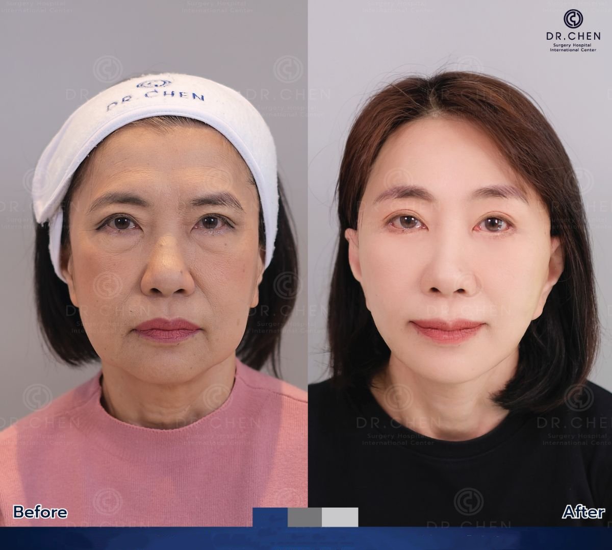 نتائج رأب الجفن قبل وبعد في Dr. Chen Surgery Hospital International Center