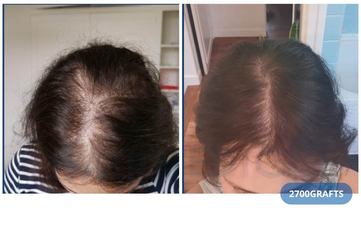 Antes y después de trasplante capilar DHI en Hairmedico Clinic, 2700 injertos para más densidad
