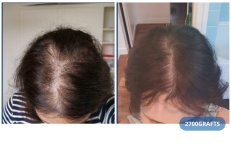 Vorher-nachher DHI-Haartransplantation bei Hairmedico Clinic, 2700 Grafts für dichteres Haar