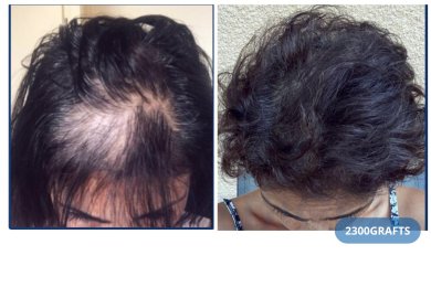 Vorher-nachher DHI-Haartransplantation bei Hairmedico, 2300 Grafts, sichtbare Haardichte