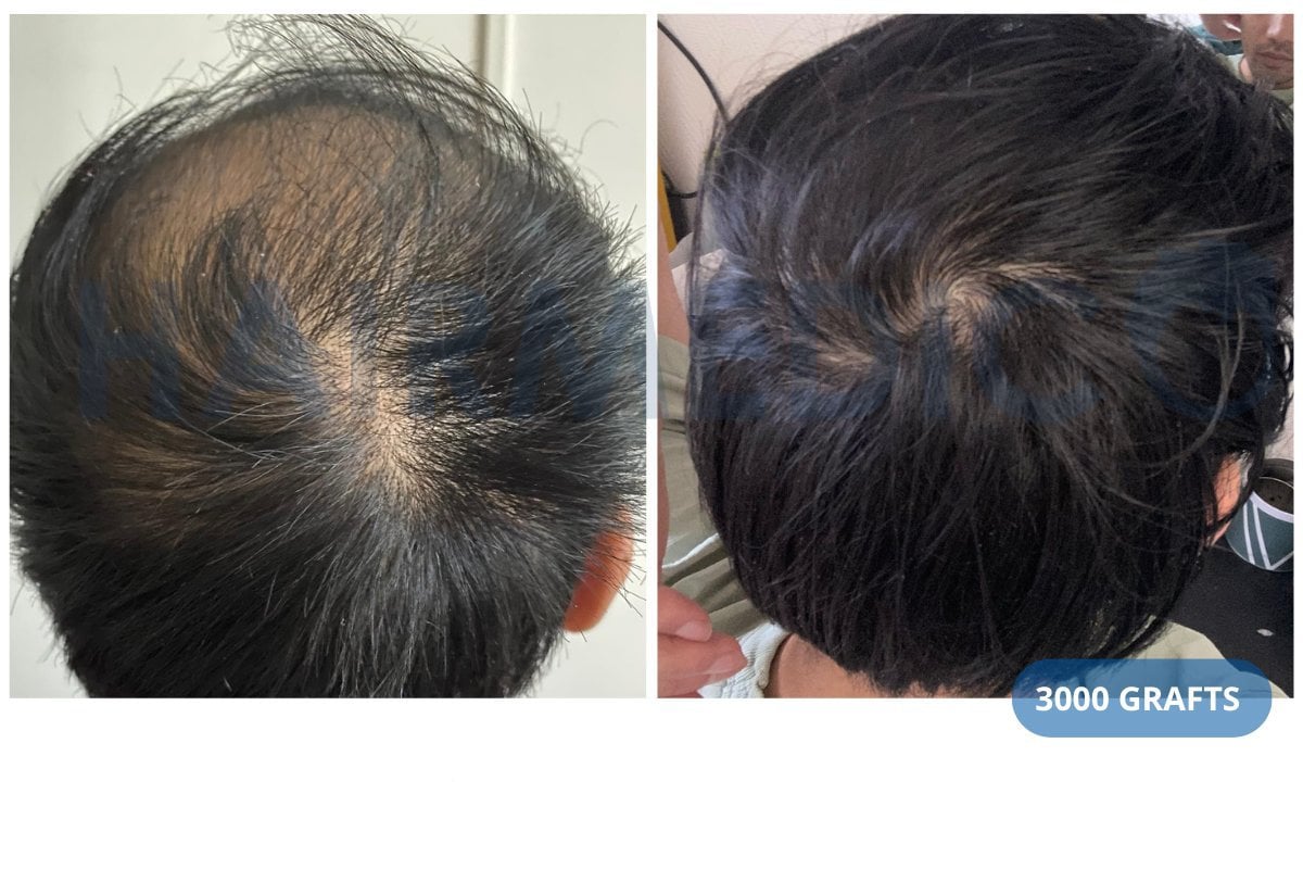 نتيجة زراعة الشعر FUE في عيادة Hairmedico قبل وبعد مع 3000 طعم