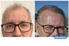 FUE-Haartransplantation Vorher-Nachher bei Hairmedico Clinic, 3300 Grafts für mehr Fülle