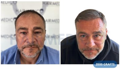 Vorher-nachher-Ergebnis FUE-Haartransplantation bei Hairmedico Clinic mit 3500 Grafts