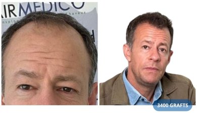 Vorher-nachher-Ergebnis FUE-Haartransplantation bei Hairmedico, 3400 Grafts verwendet