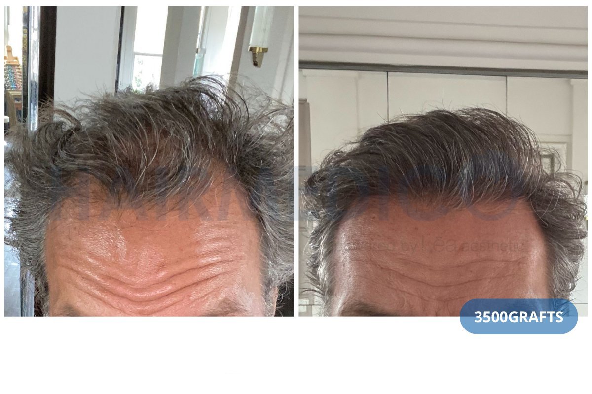 نتيجة زراعة الشعر FUE في عيادة Hairmedico، 3500 طعم، خط شعر محسن