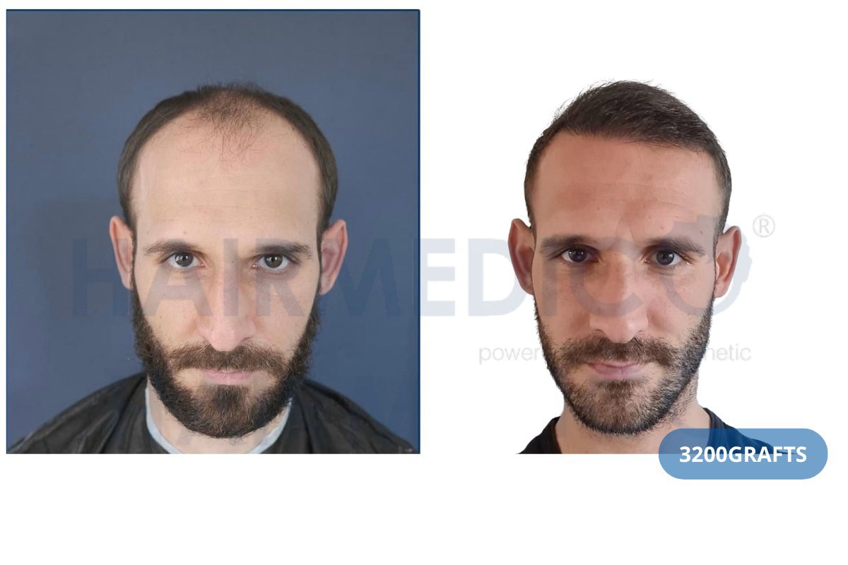 Resultado de trasplante capilar FUE en Hairmedico Clinic, 3200 injertos para la línea frontal