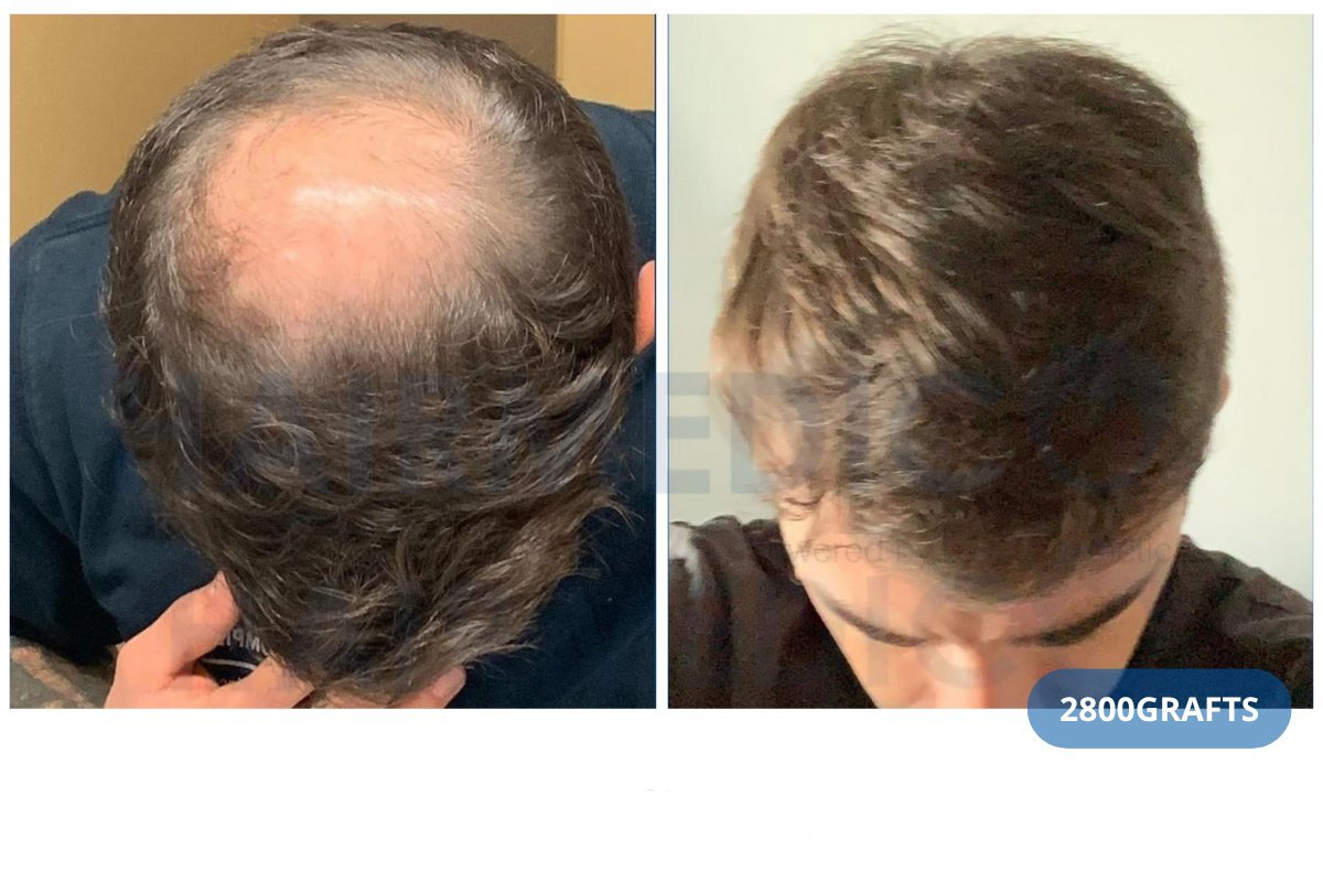 نتيجة زراعة الشعر FUE قبل وبعد في عيادة Hairmedico باستخدام 2800 طعم