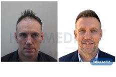 Vorher-nachher FUE-Haartransplantation bei Hairmedico, 3000 Grafts, vollere Haarlinie