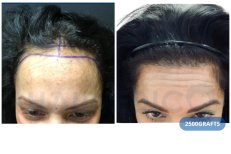 DHI-Haartransplantation Vorher-Nachher-Ergebnis bei Hairmedico Clinic, 2500 Grafts