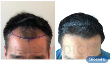 FUE-Haartransplantation Vorher-Nachher-Ergebnis bei Hairmedico Clinic, 2500 Grafts