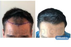 FUE-Haartransplantation Vorher-Nachher-Ergebnis bei Hairmedico Clinic, 2500 Grafts