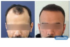FUE-Haartransplantation Vorher-Nachher bei Hairmedico Clinic, 3200 Grafts, verbesserter Haaransatz