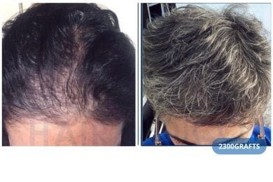 Vorher-nachher-Ergebnis der DHI-Haartransplantation in der Hairmedico Clinic mit 2300 Grafts