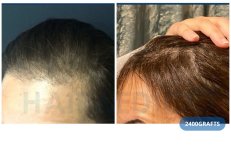 DHI-Haartransplantation Vorher-Nachher bei Hairmedico Clinic, 2400 Grafts, dichtere Haarlinie
