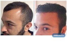 FUE-Haartransplantation Vorher-Nachher-Ergebnis bei Hairmedico Clinic mit 3400 Grafts