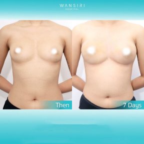 До та після збільшення грудей ліпофілінгом у Wansiri Hospital, результат за 7 днів