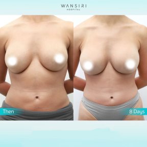 До і після збільшення грудей ліпофілінгом у Wansiri Hospital, результат за 8 днів