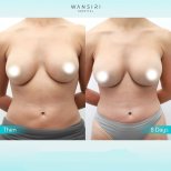 До і після збільшення грудей ліпофілінгом у Wansiri Hospital, результат за 8 днів