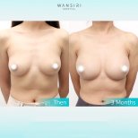 До і після збільшення грудей ліпофілінгом у Wansiri Hospital, результат за 3 місяці