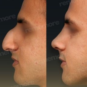 Before and after ultrasonic rhinoplasty result at Memorial Şişli Hospital, nose reshaping