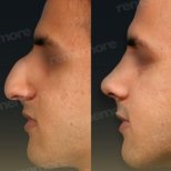 Before and after ultrasonic rhinoplasty result at Memorial Şişli Hospital, nose reshaping