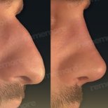 Before and after ultrasonic rhinoplasty results at Memorial Şişli Hospital, nose reshaping