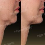 Before and after jaw shaping results at Memorial Şişli Hospital, improved chin contour
