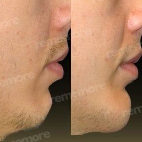 Before and after jaw shaping results at Memorial Şişli Hospital, improved chin contour