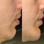 Before and after jaw shaping results at Memorial Şişli Hospital, improved chin contour