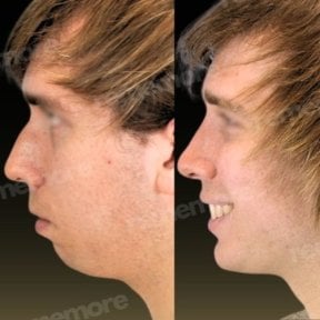 Before and after jaw shaping results at Memorial Şişli Hospital, improved chin and profile