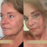 Facelift Vorher-Nachher-Ergebnisse in der Dr. Safa Manav Klinik, 6 Monate postoperativ