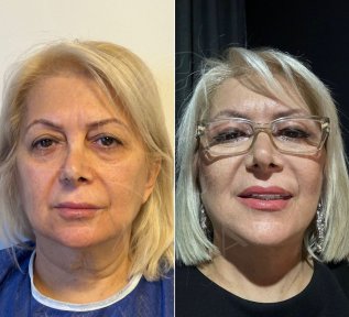 Vorher-nachher-Ergebnis Facelift bei Dr. Safa Manav Clinic, sichtbare Verjüngung